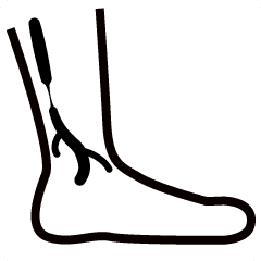 Peripheral artery disease 